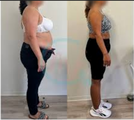 Antes e Depois Fernanda